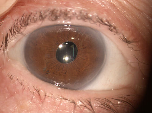 _ATLAS_4_5_post_cataract_iris_fixation_P