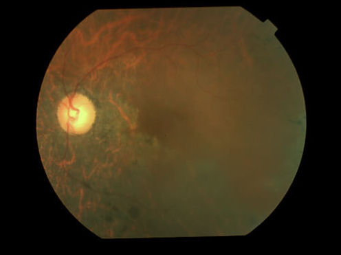 eyemds_Behcet_Retina_Clinic_2.jpg