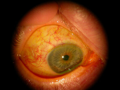 Retina_Cataract_Surgery_ATLAS_5_episcler