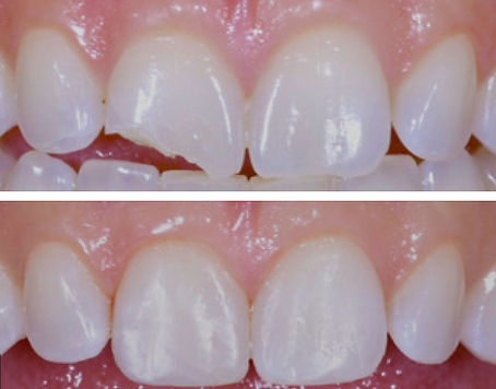 Cosmetic Bonding front teeth