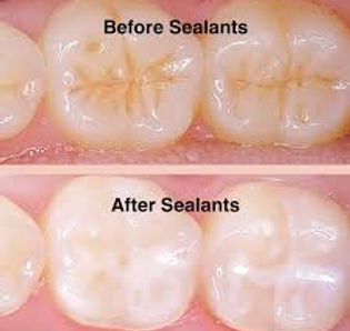 Sealants