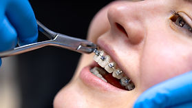 Rimozione apparecchio per denti presso Nuovo Centro Medico Euganeo dentista a Battaglia Terme