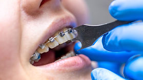 applicazione dell'apparecchio sugli adulti presso Nuovo Centro Medico Euganeo dentista a Battaglia Terme