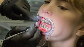 applicazione dell'apparecchio sui bambini presso Nuovo Centro Medico Euganeo dentista a Battaglia Terme