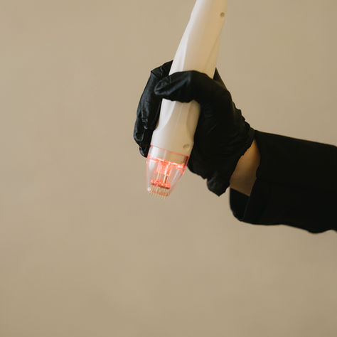 Why RF Microneedling with Vivace Ultra® Is the Future—And Why PRP Just Can’t Keep Up