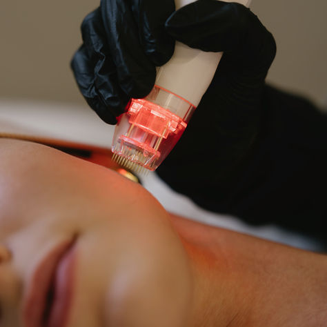 RF Microneedling, Backed by Research: The Science of Smoother, Firmer, Healthier-Looking Skin