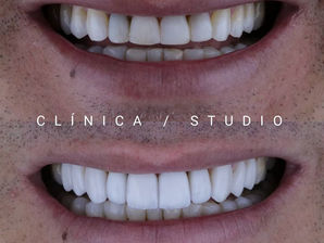 As facetas de porcelana Studio podem mudar minha vida?