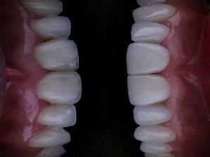 Facetas de Porcelana Studio: Quais as principais indicações?