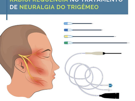 Radiofrequência no tratamento de neuralgia de trigêmeo