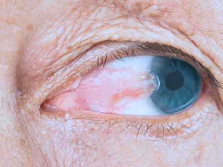 Cirurgia de pterígio e lentes de contato: Uma visão mais clara