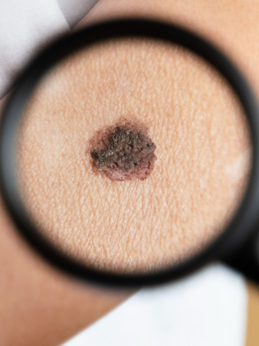 ABCDEs of melanoma