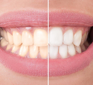 Start-Pure-teeth-whitening.jpg.optimal.jpg