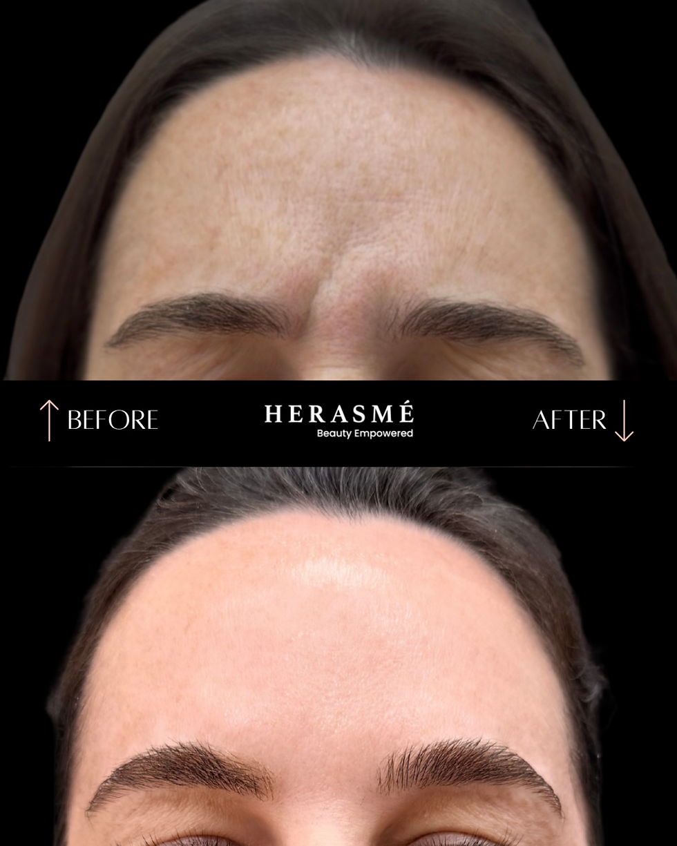 Before and after results of a forehead wrinkle relaxer treatment at Herasme Beauty in Englewood, NJ — smoother forehead and softened expression lines following treatment with board-certified NP Michelle Herasme.