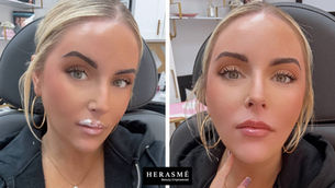 Woman with light hair in a beauty clinic, showing before and after lip enhancement. Setting includes shelves and beauty products. Text: HERASMÉ Beauty Empowered.