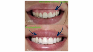 Gengivoplastia e Botox para Sorriso Alto: Como Melhorar sua Estética com Segurança