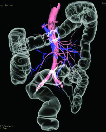 CTC,Angio,合成画像
