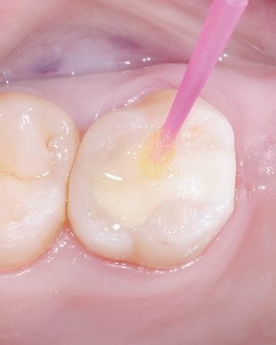 restauracao diretas de resina composta.j