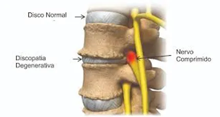 Resultado de imagem para degeneração dos discos intervertebrais