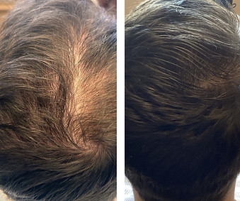 Hair Restoration