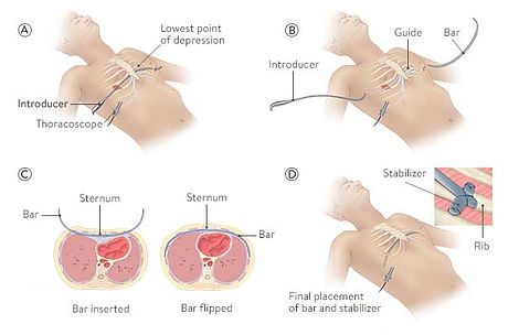 nuss-procedure.jpg
