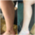Burn scar cover