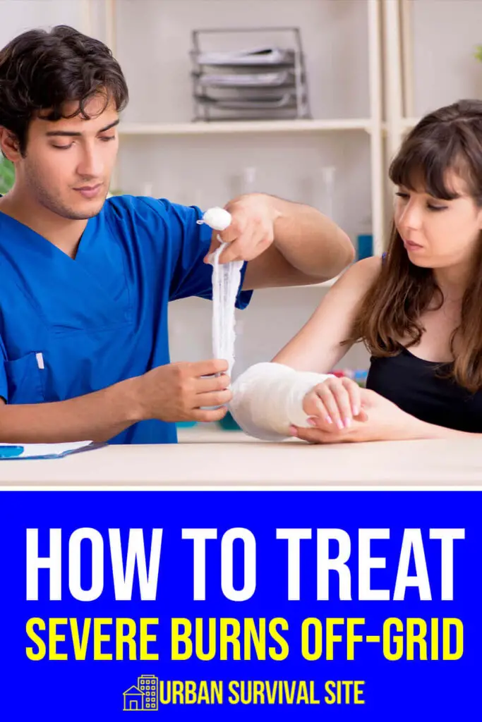 how-to-treat-severe-burns-off-grid-pin-1-683x1024.webp