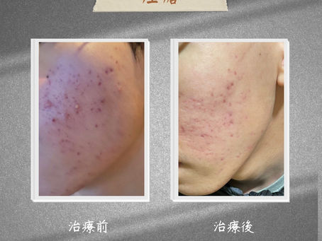 痤瘡