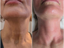 RF Microneedling vs HIFU – Which Is Better For Skin Lifting and Skin Rejuvenation?