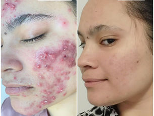 Effective Acne Treatments and Why You Should Never Pop Your Pimples