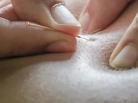 Dry Needling Therapy
