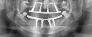 Clinical Case: Immediate Full-Arch-on-Four Rehabilitation with GDT RBM Implants