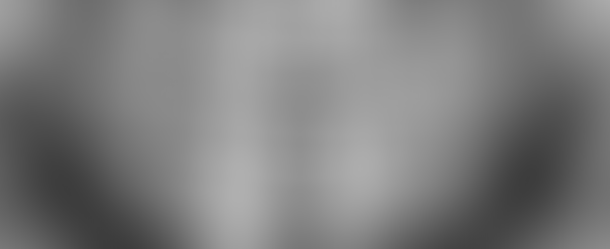 Clinical Case: Immediate Full-Arch-on-Four Rehabilitation with GDT RBM Implants