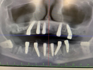 Clinical Case: Full-Arch Rehabilitation using GDT Multi-unit abutments
