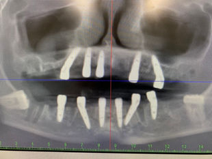 Clinical Case: Full-Arch Rehabilitation using GDT Multi-unit abutments