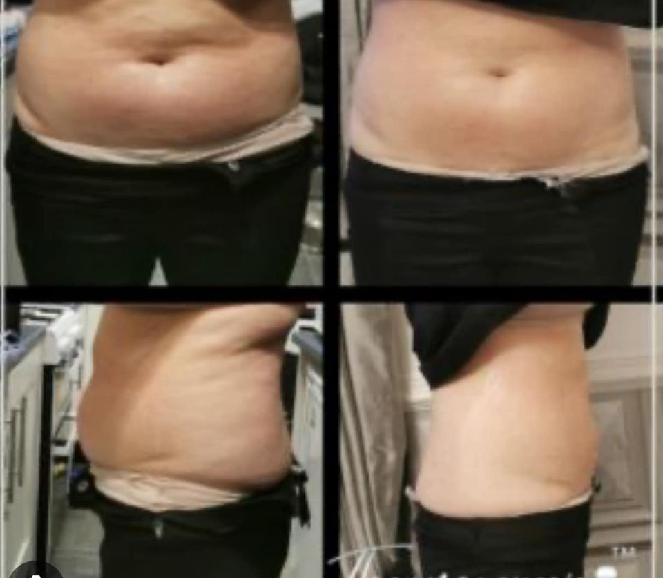 Before & After photos of female clients with Successful RF Treatments