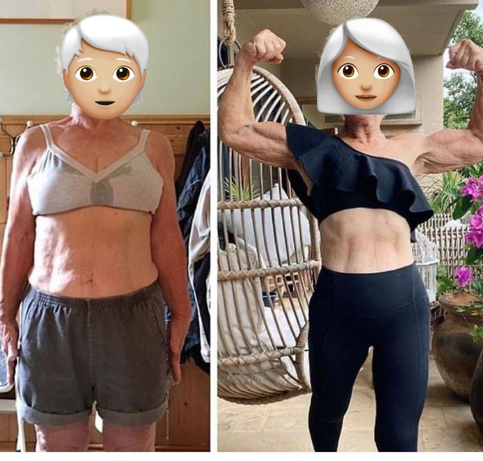 Before & After photos of GLP Weight Loss Success and RF Treatments