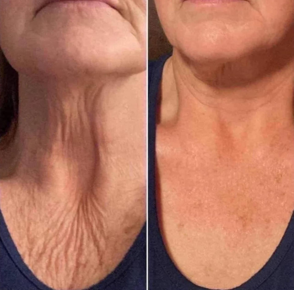 Before and After photos of client neck with Nano & RF Treatments