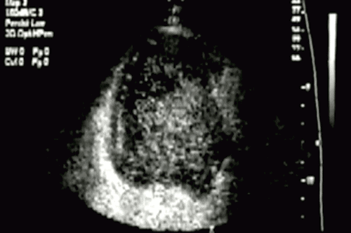 Contrast of heart due to microbubble