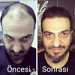 “Transformation through hair transplant organized by Boris Hair Studio with full support”