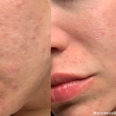morpheus8-before-after-dr-g-ellis-preview-1.jpg