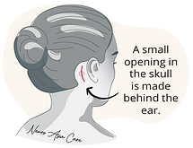 Microvascular decompression is a new treatment option for trigeminal neuralgia when medication fails. It involves making a tiny opening in the skull behind the ear. Dr Nicolas Kon is a very experienced trigeminal neuralgia specialist in Singapore and has the best results for microvascular decompression surgery.