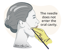 How is radiofrequency ablation done in Singapore? Consult Dr Nicolas Kon who is a trigeminal neuralgia specialist in Singapore and has the best results for radiofrequency.