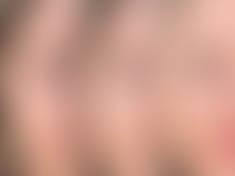 OPTE Is the High-Tech Way to Treat Dark Spots