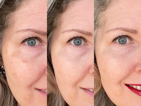 OPTE Is the High-Tech Way to Treat Dark Spots