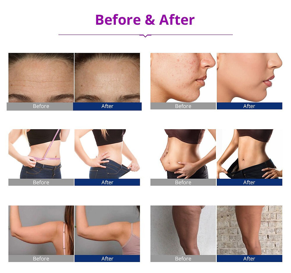Thumbnail: 5in1 Multipolar RF Skin Tightening Vacuum 40K Cavitation Ultrasonic Celliute