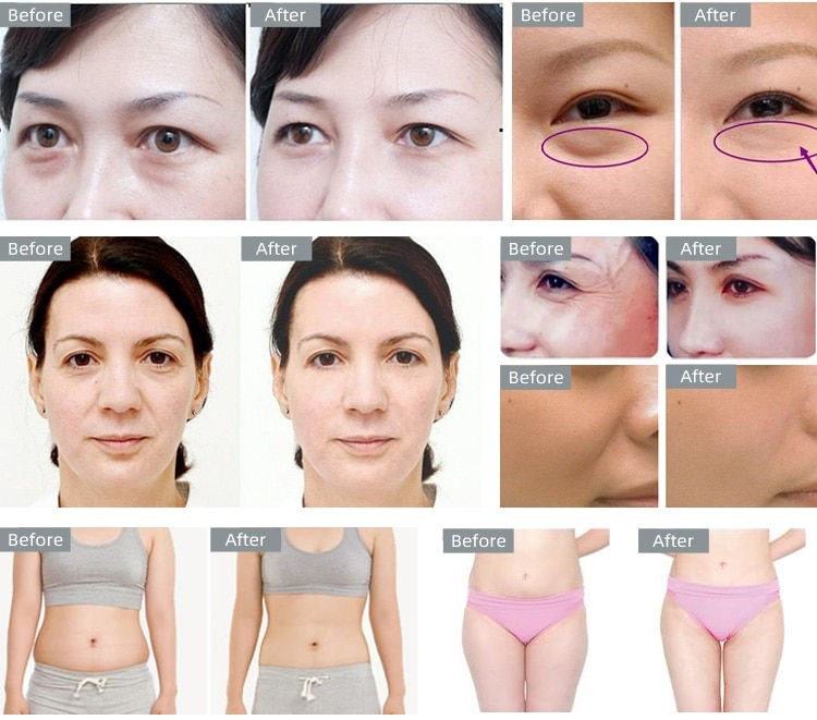 Thumbnail: Body Slimming 40K Cavitation Ultrasonic Weight Loss Skin Rejuvenation Beauty