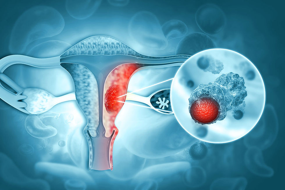 endometrial cancer
