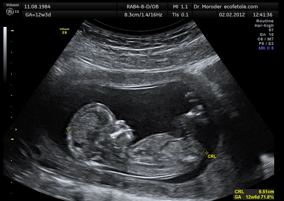 weeks 11 pregnancy scan