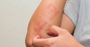 Gece kaşıntıdan uyuyamıyor musunuz? UYUZ NEDİR?