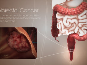 FDA Approves Blood Test for CRC